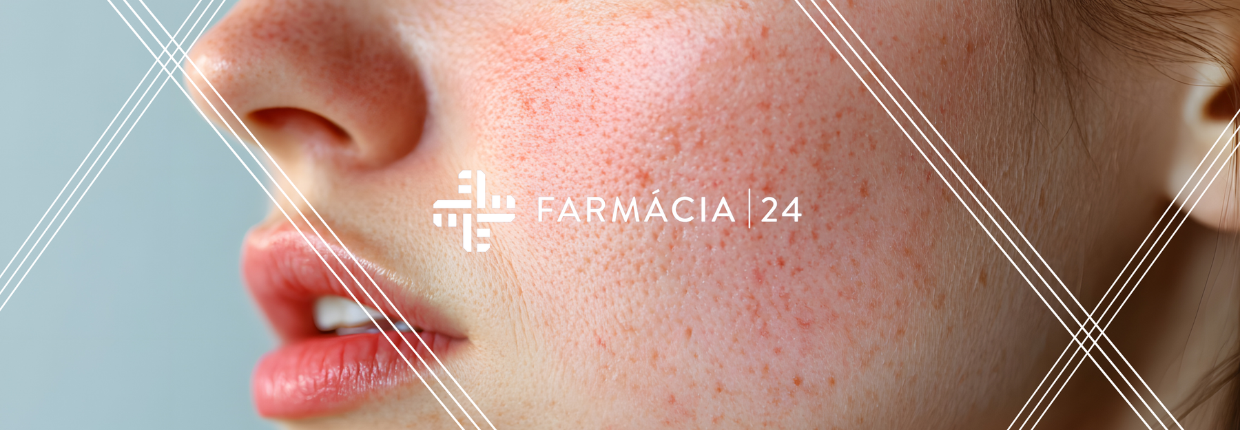 Quick-Guide: Cuidados com a pele sensível, vermelhidão e rosácea no frio