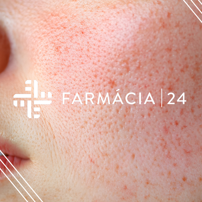 Quick-Guide: Cuidados com a pele sensível, vermelhidão e rosácea no frio