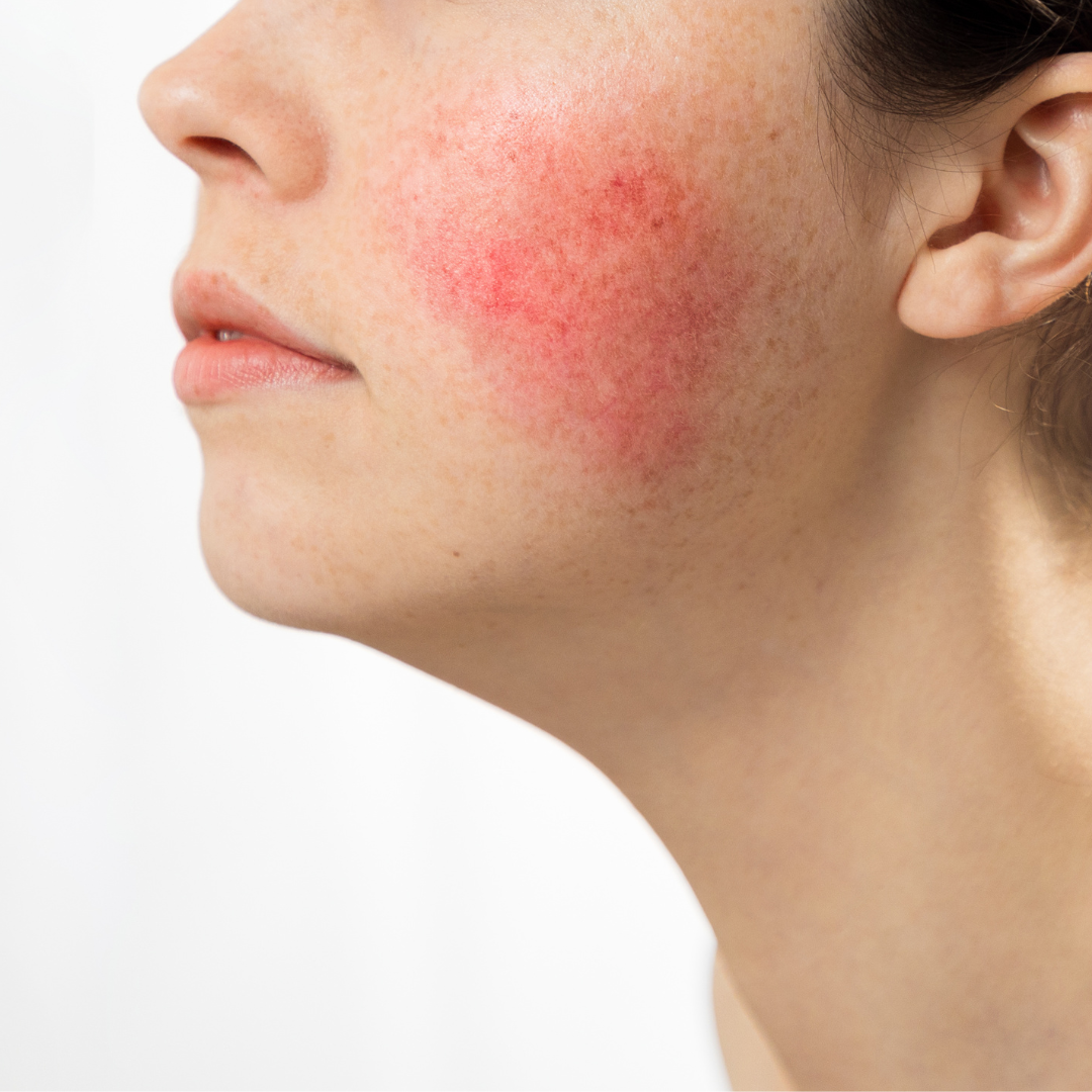 Vermelhidão e Rosácea