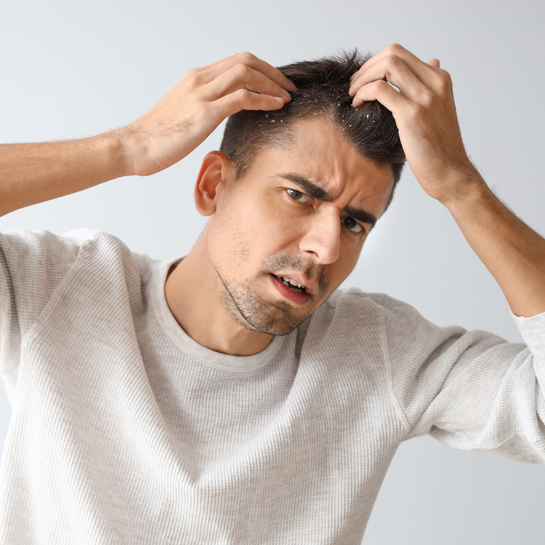 Dermatite Seborreica