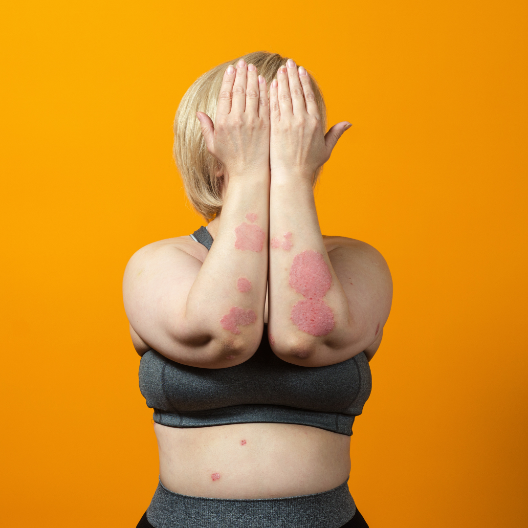 Psoríase e Dermatite Seborreica