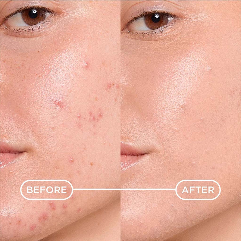 Bioderma Sébium Kerato+ Cover Gel-Creme c/Cor Pele Acne 30ml